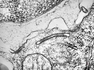 M,7m. | Birbeck granules (Langerhans granules, X-granules) - skin, histiocytosis X